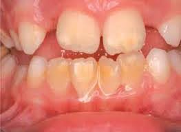 Denti a macchie, ecco la malattia dei bambini degli anni Duemila