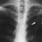 Tubercolosi polmonare bacillifera bilaterale poliresistente, sospetto multiresistente